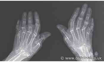 Is arthritis making your life a misery? Try a workout... or a chat!