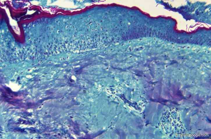 Monkeypox Has Undergone “Accelerated Evolution”, Mutating At Unprecedented Rates - IFLScience