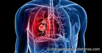 Coronavirus complication: Know how COVID damages your lungs - Times of India