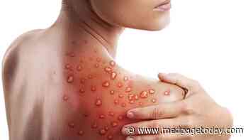 Your Monkeypox Questions Answered