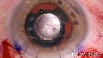 Bari, lente telescopica impiantata al Policlinico: "Chi ha una cataratta torna a vedere da vicino" - La Repubblica