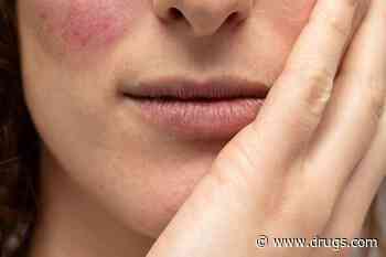 Twelve-Week Treatment Regimen Reduces Facial Redness