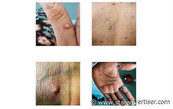 Monkeypox is present in Hawaii; vaccine, treatments available