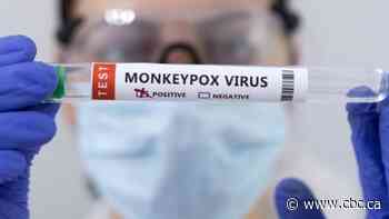 Hamilton confirms 1st case of Monkeypox