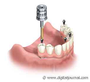 Bexley Dentist Advises Patients To Seek Dental Implants - Digital Journal
