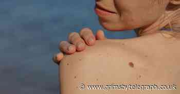 The 'silent changes' that could be a sign of skin cancer - Grimsby Live