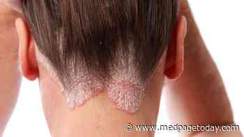 Which Biologics Stick Longest for Psoriasis?