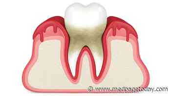 People With Gum Disease Are More Prone to Heart Failure