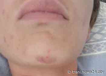 Colpita con liquido urticante mentre è in auto al semaforo - Trani News24 City