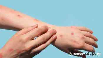 Sesap confirma 2º caso de varíola dos macacos em Natal - Agência SAIBA MAIS