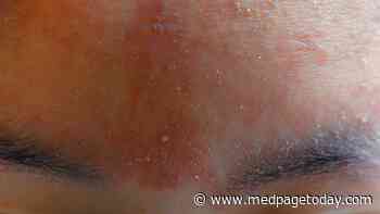 Chronic, Disfiguring Facial Rash With No Itching or Pain