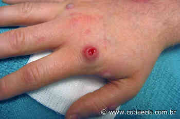 Itapevi registra 4 casos de varíola dos macacos; Osasco tem 2 - Cotia e Cia