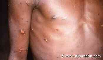 Variole du singe: la vaccination sera possible dès le 18 juillet au CHU de Nice