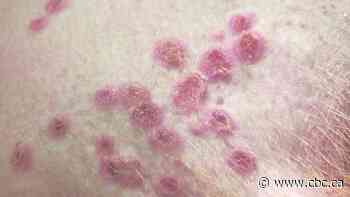 Saskatchewan reports 1st confirmed case of monkeypox