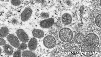 1st monkeypox case reported in Sask.