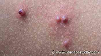 Novel Nitric Oxide Gel Clears Kids' Molluscum Contagiosum Lesions