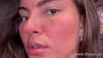 Love Island’s Rebecca Gormley unrecognisable without make-up after suffering horrific sunburn... - The Irish Sun