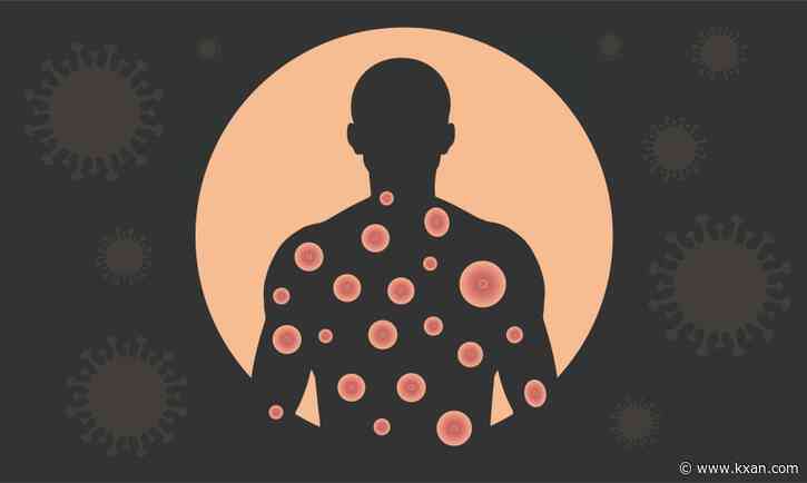 Monkeypox in Austin: Public health leaders to give briefing Thursday