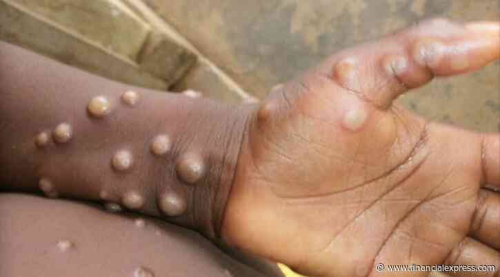 Kerala reports India’s first monkeypox case; Centre rushes high-level team for effective management