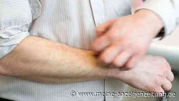 Geplagt von Mückenstichen: Das lockt die Plagegeister besonders an