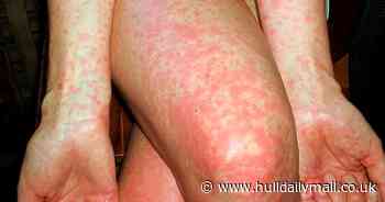 Sudden rise in scarlet fever cases across Hull - Hull Live