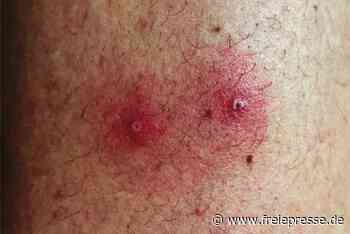 Erste Fälle von Affenpocken in Chemnitz bestätigt - freiepresse.de