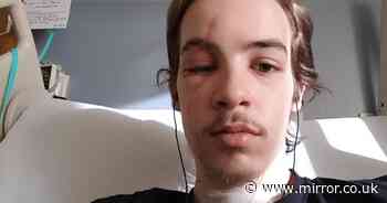 Man's eyeball popped out and he inhaled glass when van hit him as he crossed street