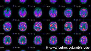 New Insights into Melanoma Brain Metastases - Columbia University Irving Medical Center