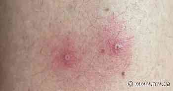 Affenpocken: Ein bestätigter Fall im Kreis Minden-Lübbecke - Neue Westfälische