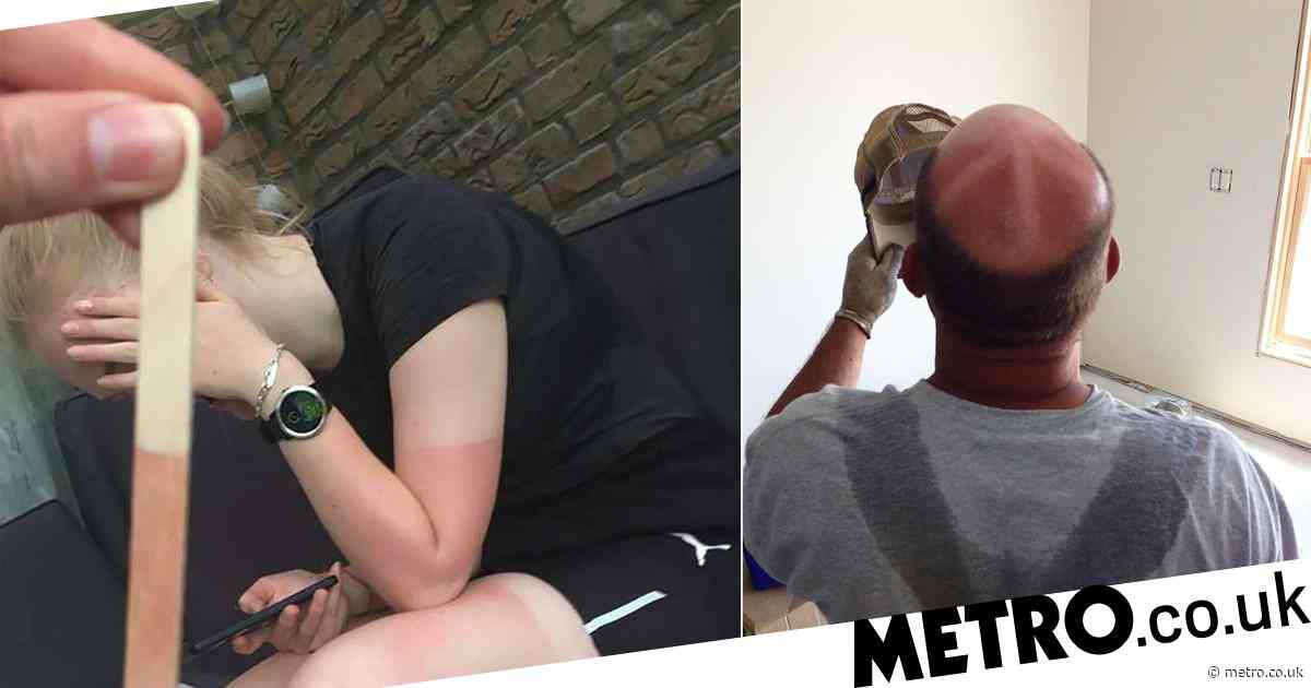 People Share Their Worst Ever Sunburns And Tan Lines UK News NewsLocker