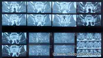 Study: Don't Assume Spinal Findings on MRI Signify Spondyloarthritis
