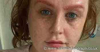 Woman left feeling like a 'monster' after eyebrow tinting went wrong - Grimsby Live