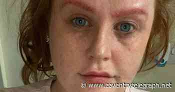 Coventry woman whose eyebrows fell off after tint went wrong feels like 'monster' - Coventry Live