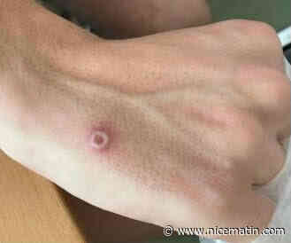 Un premier cas de variole du singe a été détecté en Principauté de Monaco