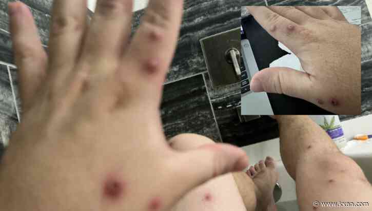 Austin man describes excruciating monkeypox symptoms, difficulty getting treatment