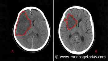 Does Additional MRI Help CT-Diagnosed Stroke Patients?