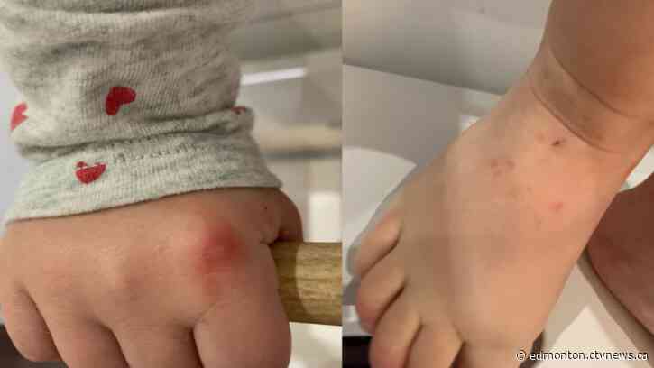 Hand-foot-and-mouth disease cases in Alberta childcare centres see dramatic increase
