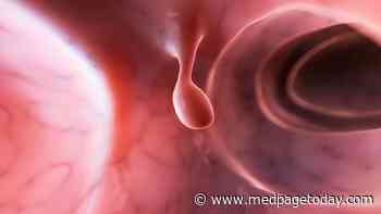 Serrated Polyp Detection a Good Indicator of Colonoscopy Quality