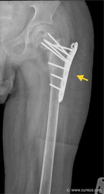 Multiple Primary Aneurysmal Bone Cysts: A Case Report and Literature Review - Cureus