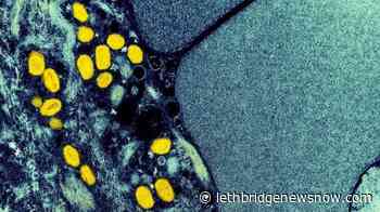 Dancer tells of excruciating pain, isolation and stigma of monkeypox infection - Lethbridge News Now