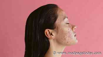 Dear Acne: You've Ruined My Life, I Hate You
