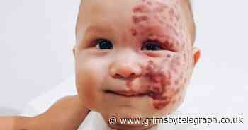 Mum called 'monster' for having laser treatment on baby's facial birthmark - Grimsby Live