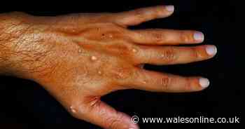 Monkeypox declared global emergency by World Health Organisation