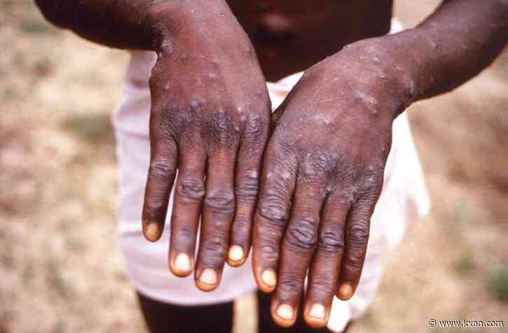 World Health Organization declares monkeypox a global emergency