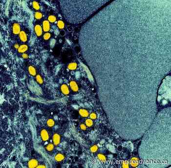 Dancer tells of excruciating pain, isolation and stigma of monkeypox infection - Virden Empire Advance