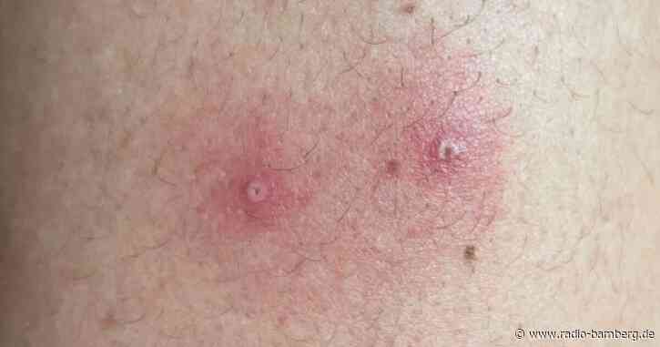 Affenpocken als Notlage: Was über den Ausbruch bekannt ist