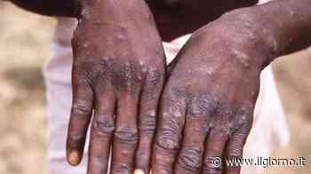 Vaiolo delle scimmie, due casi in provincia di Cremona - IL GIORNO