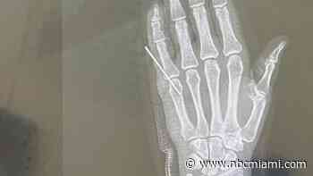 Man Nearly Loses Pinky Finger During Shark Encounter in the Florida Keys