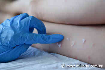 Juazeiro possui 3 casos suspeitos de varíola dos macacos - Site Miséria