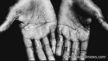 Casos de viruela del mono aumentan a 37 en Colorado